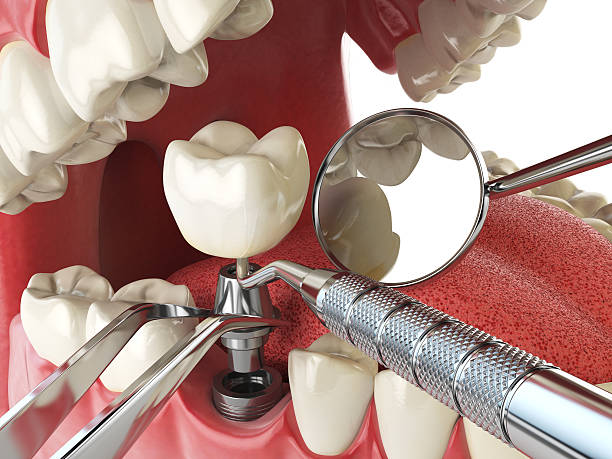 Best Urgent Tooth Repair  in Montrose, VA